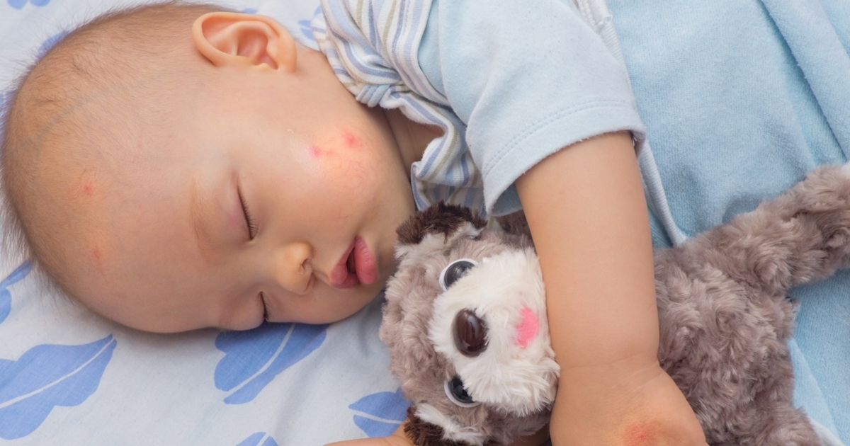 Bug Bites in Babies Symptoms You Shouldn’t Ignore